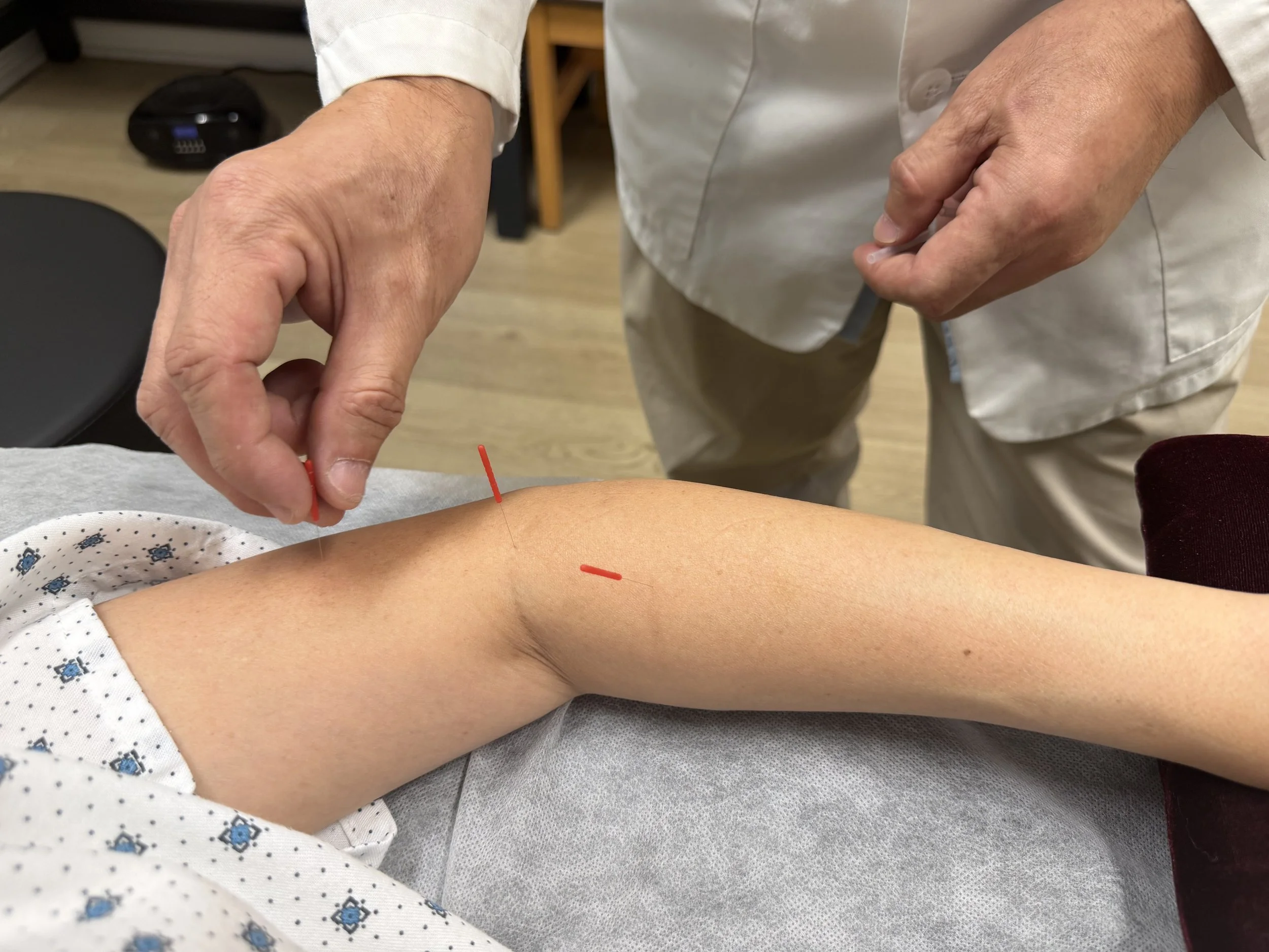 Close-up of a healthcare professional performing acupuncture on a patient's arm, with the patient lying down on a medical bed and wearing a white and blue patterned hospital gown.