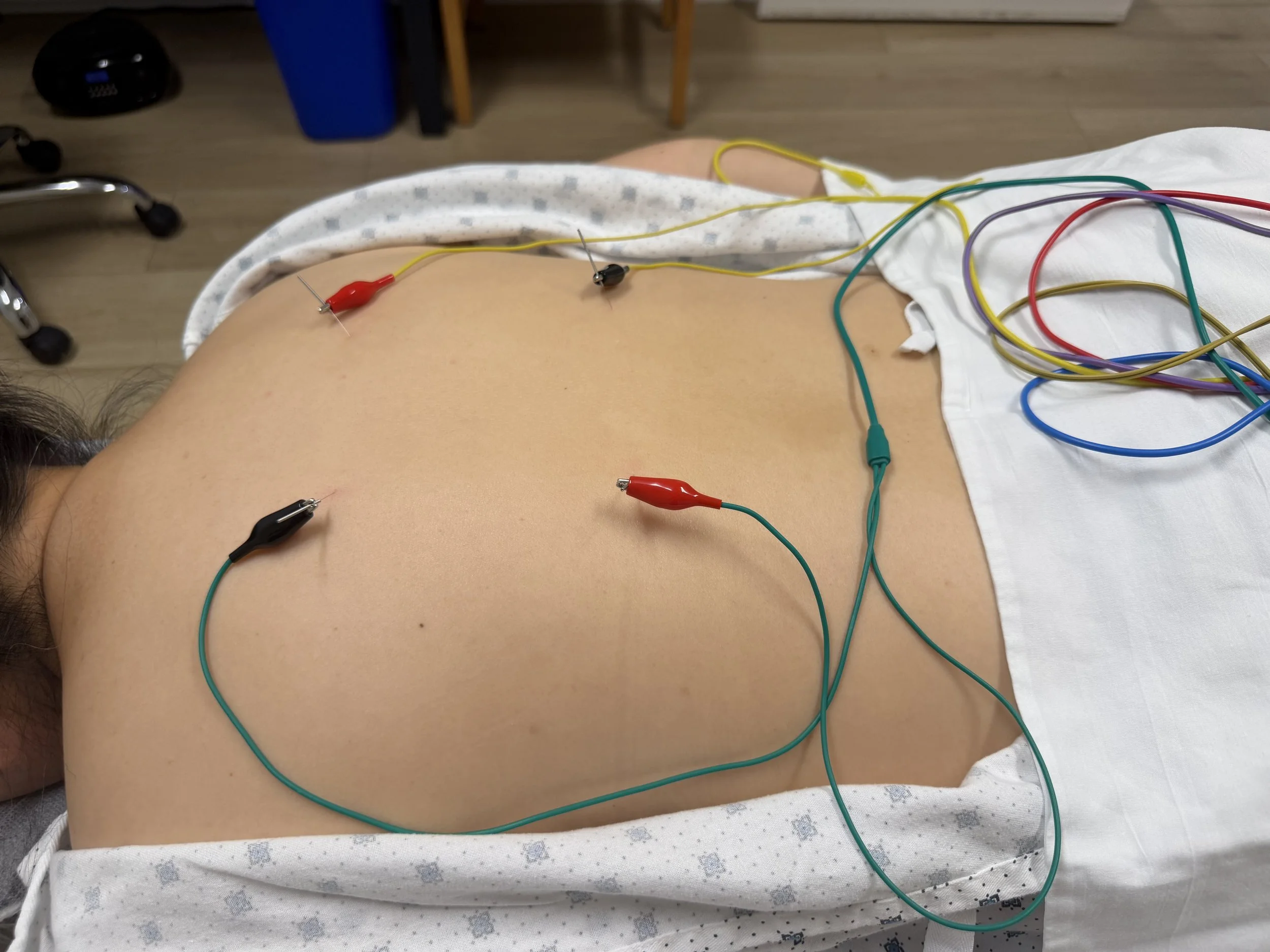 A person lying on a hospital bed with acupuncture needles and colorful electrical wires attached to their back, preparing for acupuncture treatment.