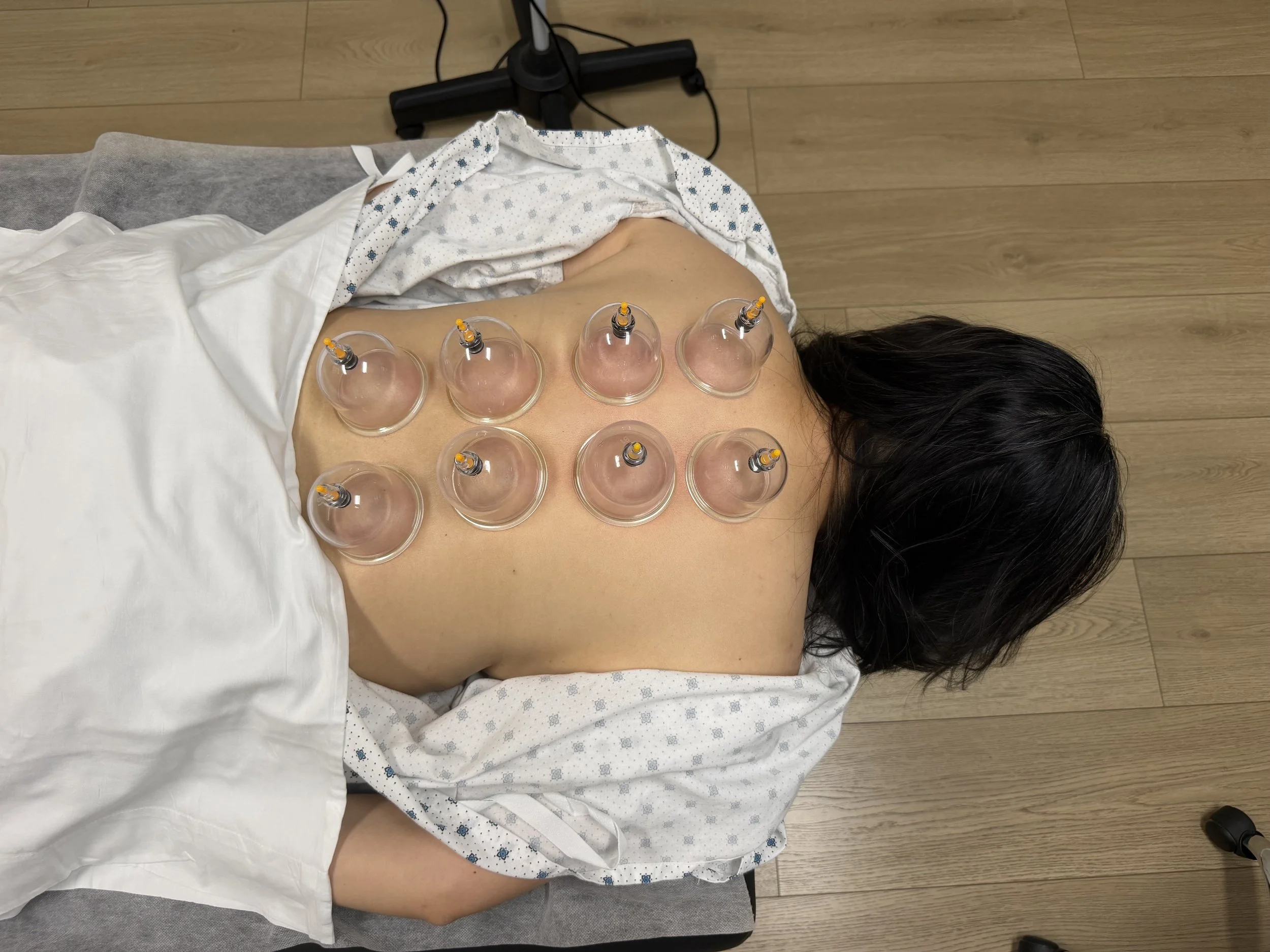 A woman lying face down on a medical examination table with a medical gown partially covering her back. Multiple cups with syringes are attached to her back, indicating a cupping therapy session.