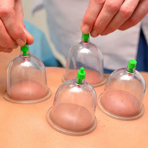 Person performing cupping therapy with four plastic cups on patient's back.