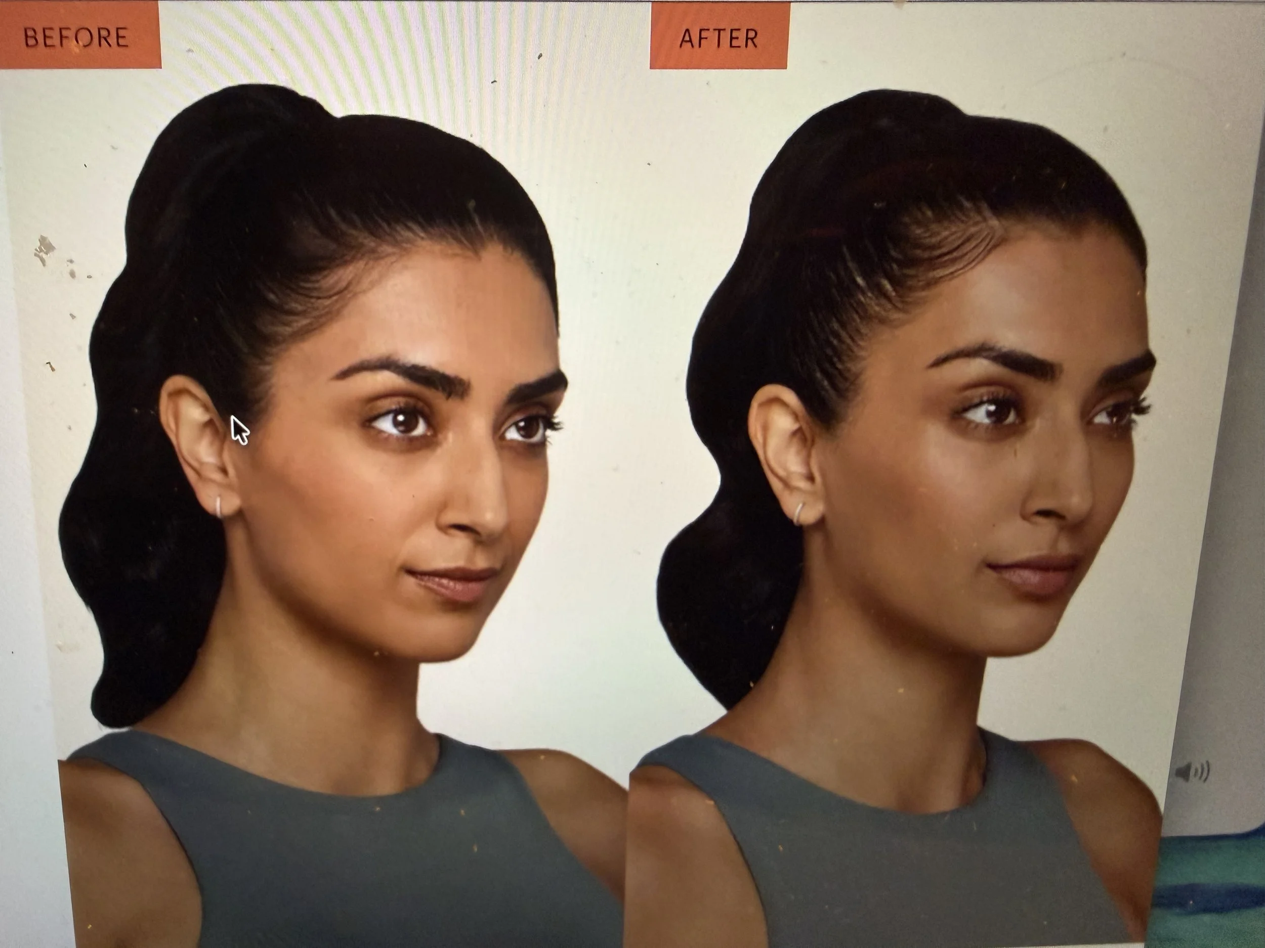 Dermal Fillers