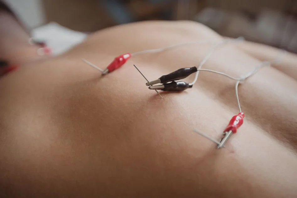 Electro-acupuncture