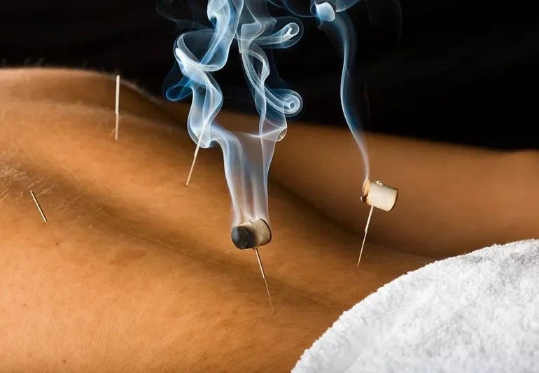 Moxibustion