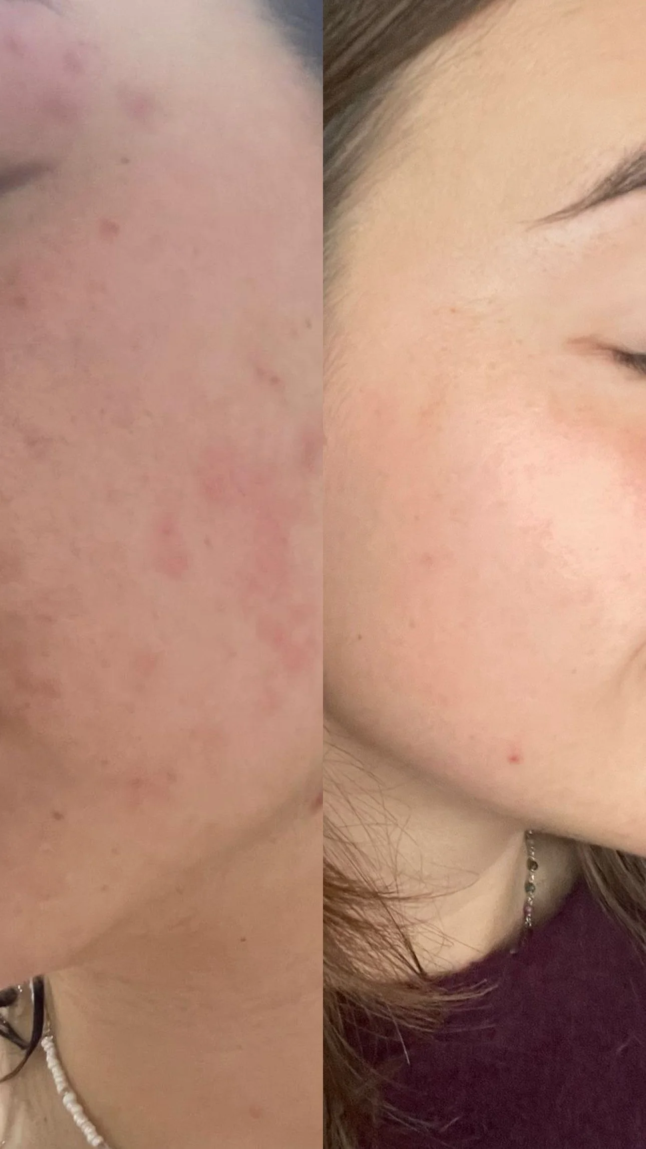 Acne op volwassen leeftijd: wat je lichaam je eigenlijk probeert te vertellen