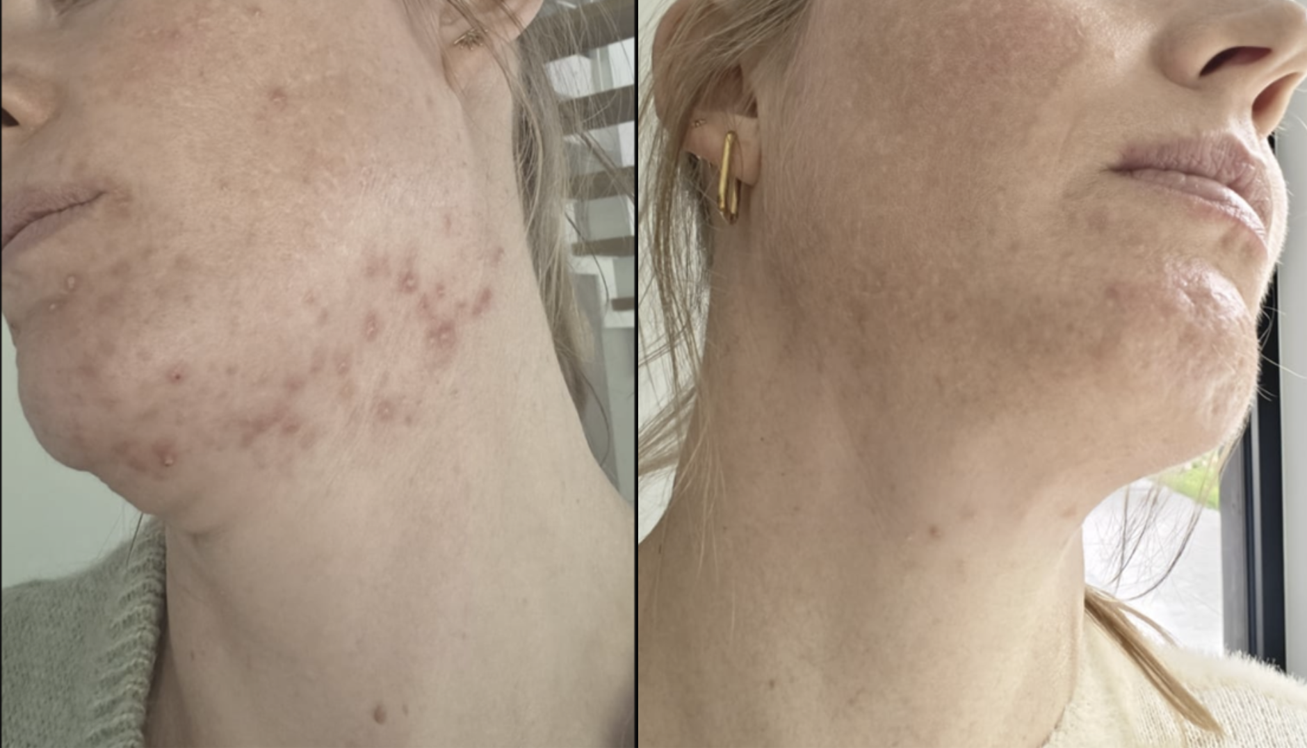 “Na 9 maanden therapie was mijn acne er nog steeds.” - Annelies, 38