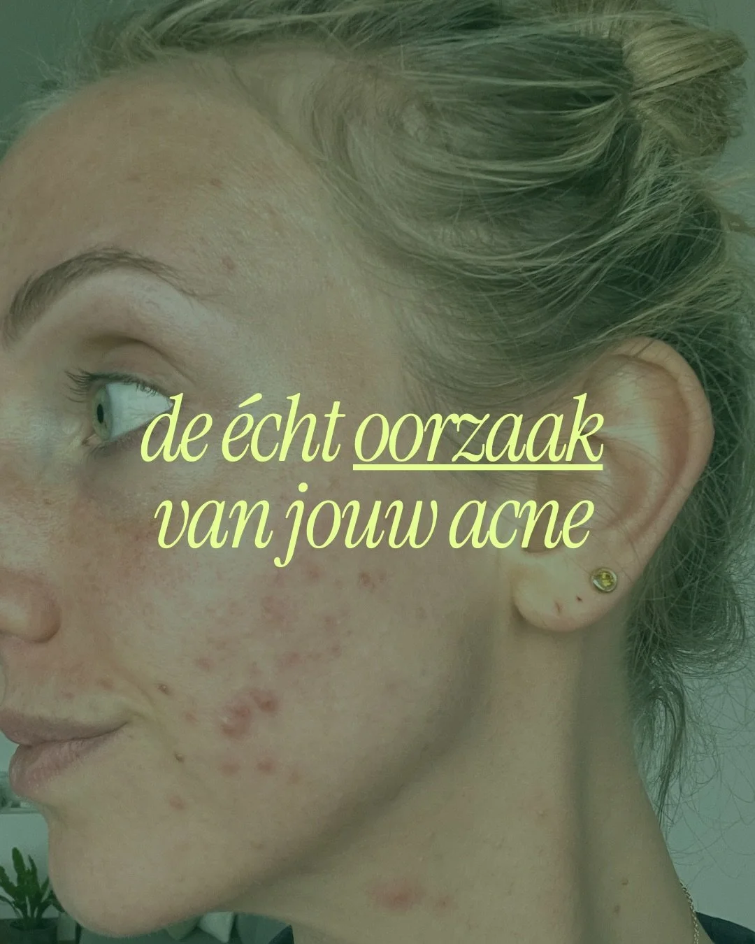 Hoe kan je nu de echte oorzaak van je acne vinden? Ik help je alvast op weg! Ik weet welke struggle je doorgaat, ik weet wat voor deuk het is op je zelfvertrouwen.. 

Hopelijk kan dit al helpen! 
Herken je je in bepaalde klachten? Reageer het even hi