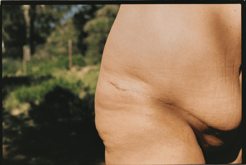 Parte del cuerpo humano con marcas de cicatrices en la piel, en un entorno natural al aire libre.