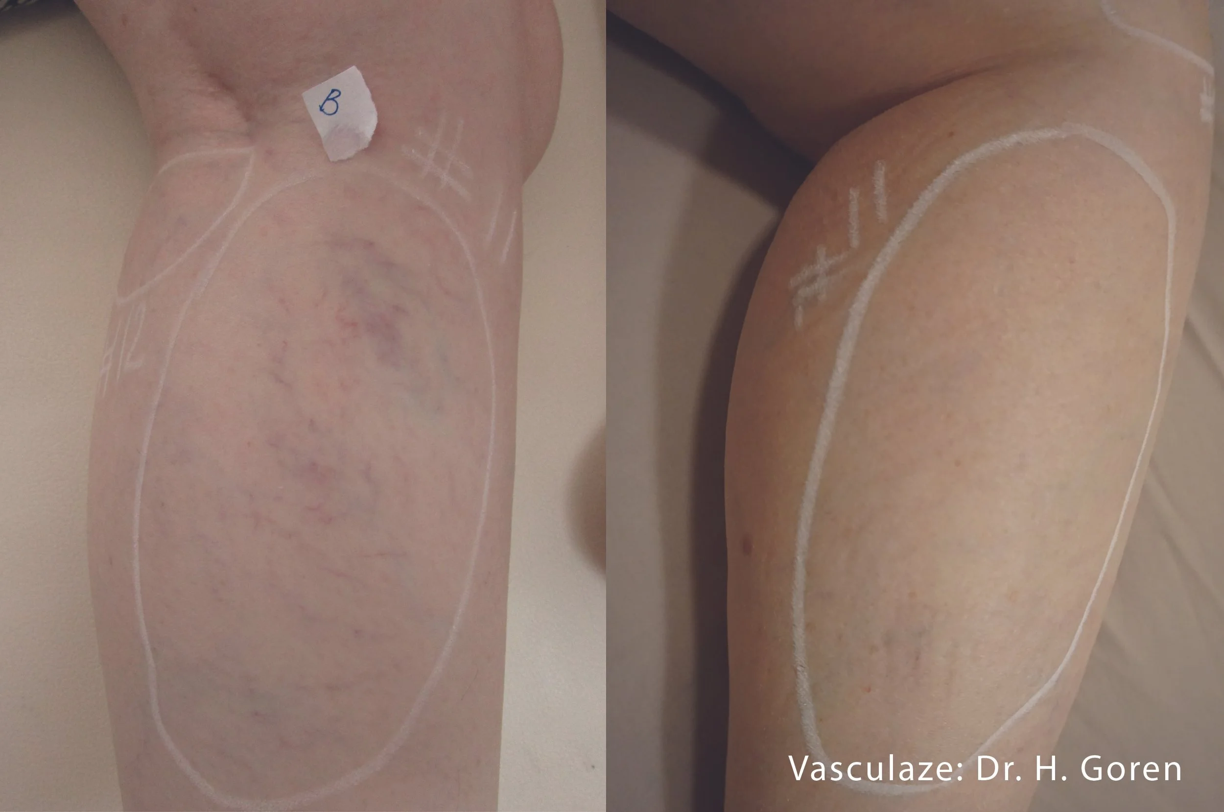 Laser Vein Treatment Before & After- Hilliard, Ohio- Serenity Wellness & Aesthetics