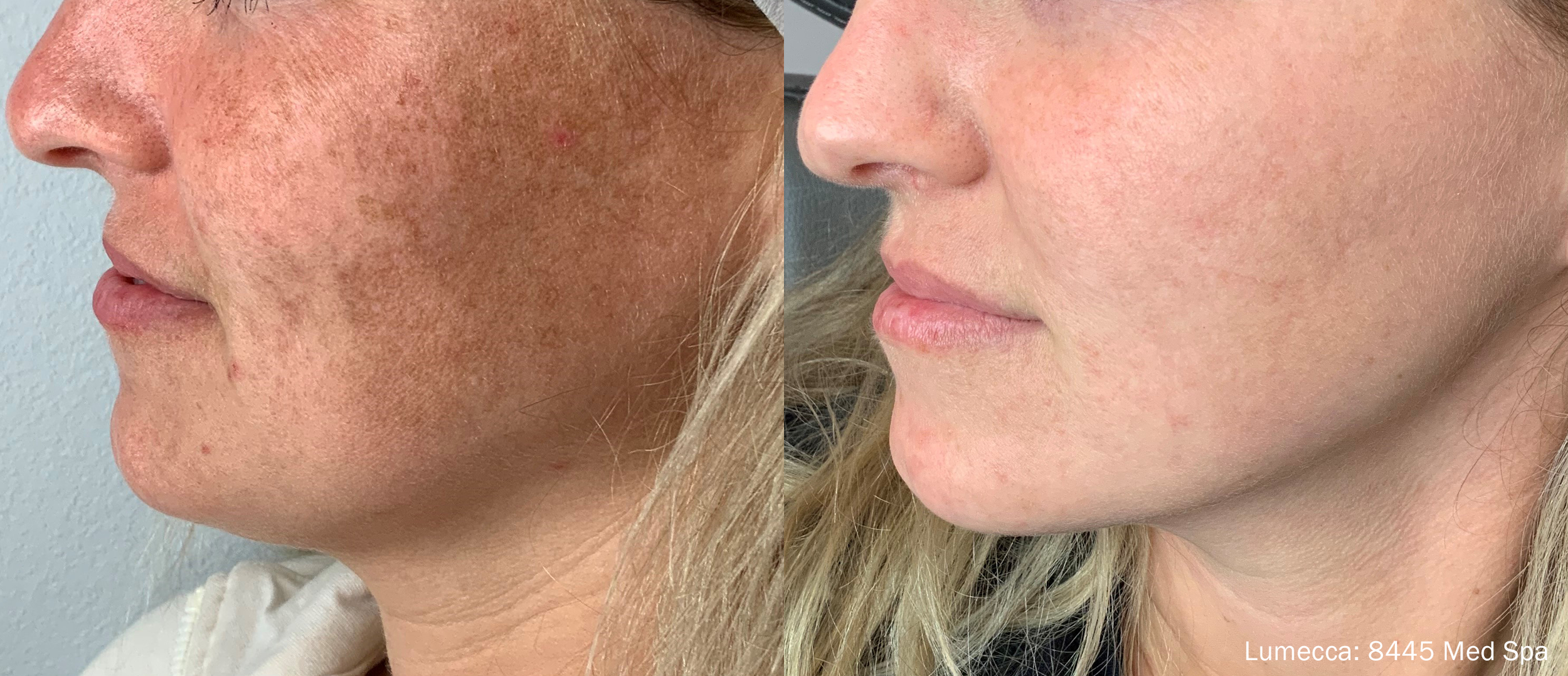Lumecca IPL Before & After, Serenity Wellness & Aesthetics in Hilliard Ohio
