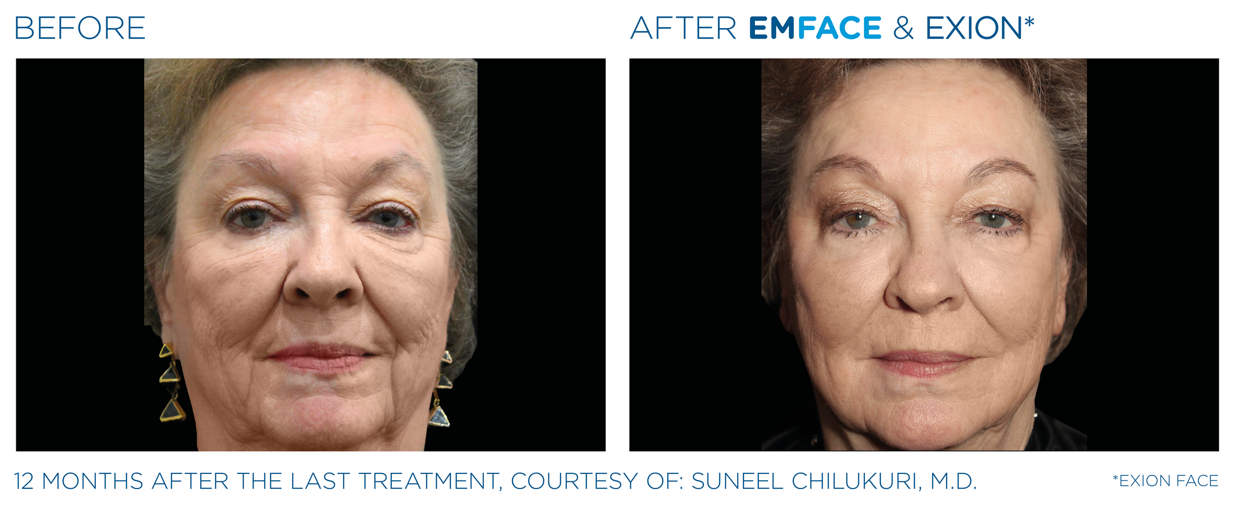 Microneedling before and after