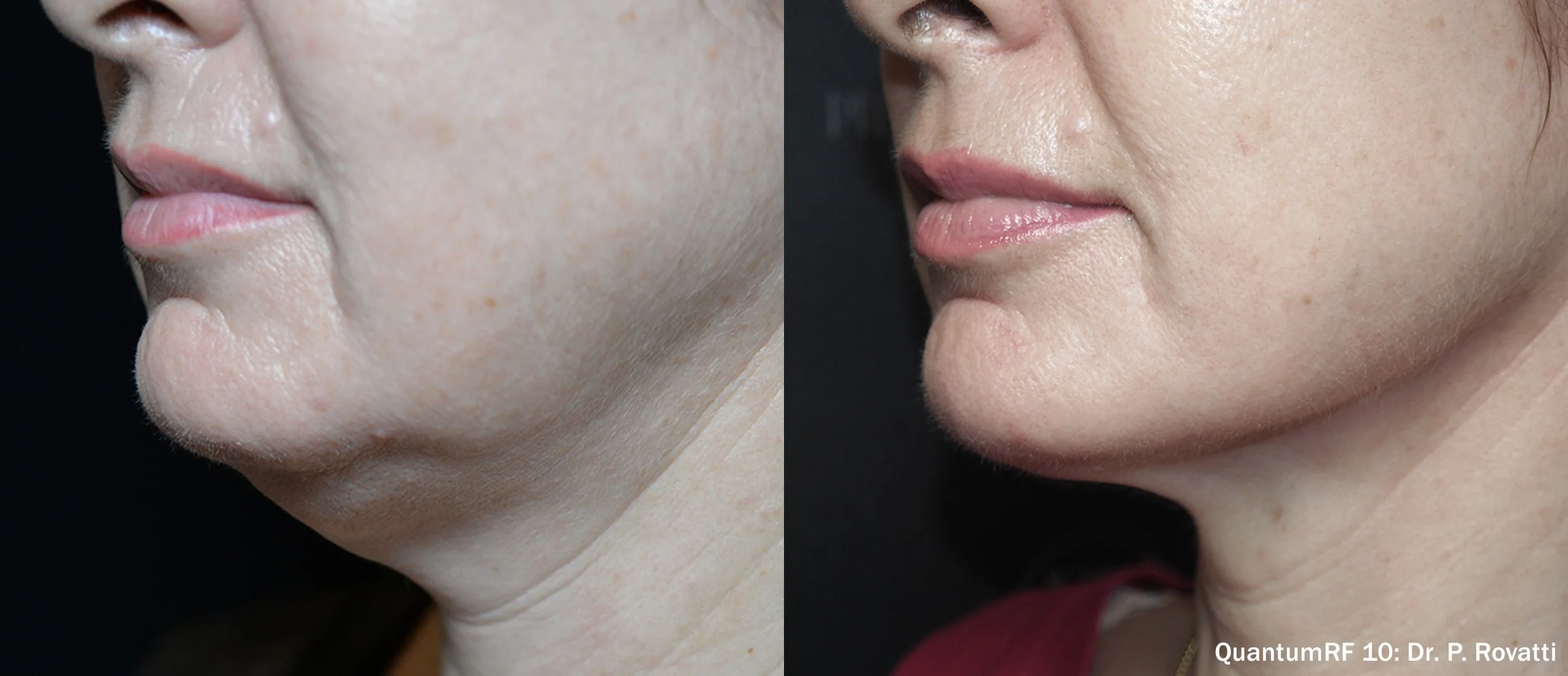 Close-up comparison of a person's lower face and chin before and after skincare or cosmetic treatment, showing smoother skin on the right.