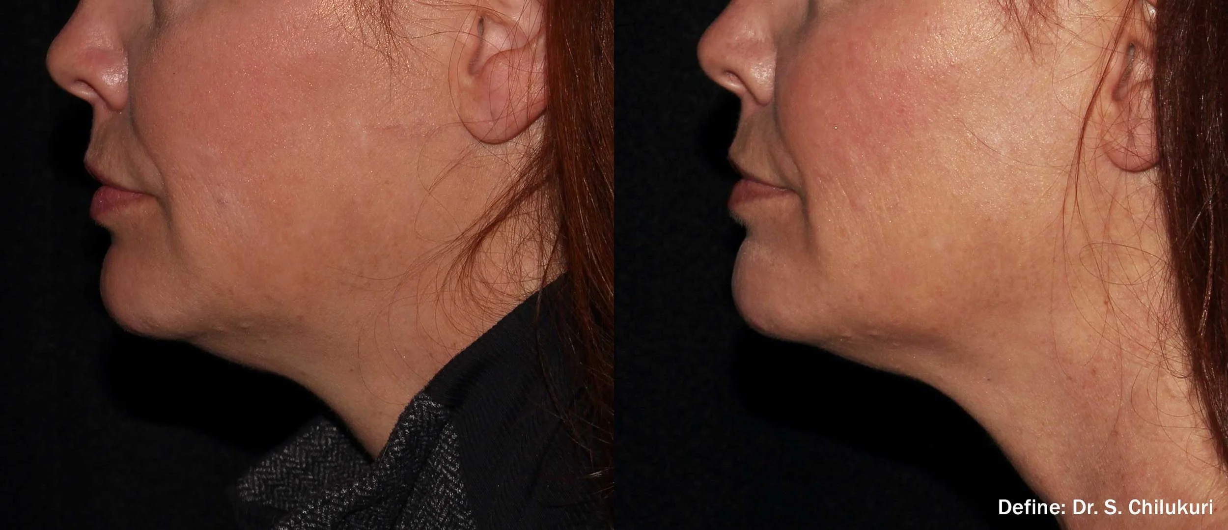 Define Jawline Contouring Before and After- Hilliard, Ohio- Serenity Wellness & Aesthetics