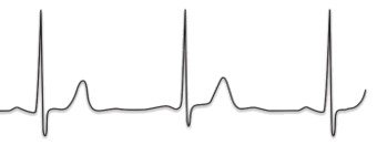Electrocardiogram (ECG) trace showing heart rate and rhythm.