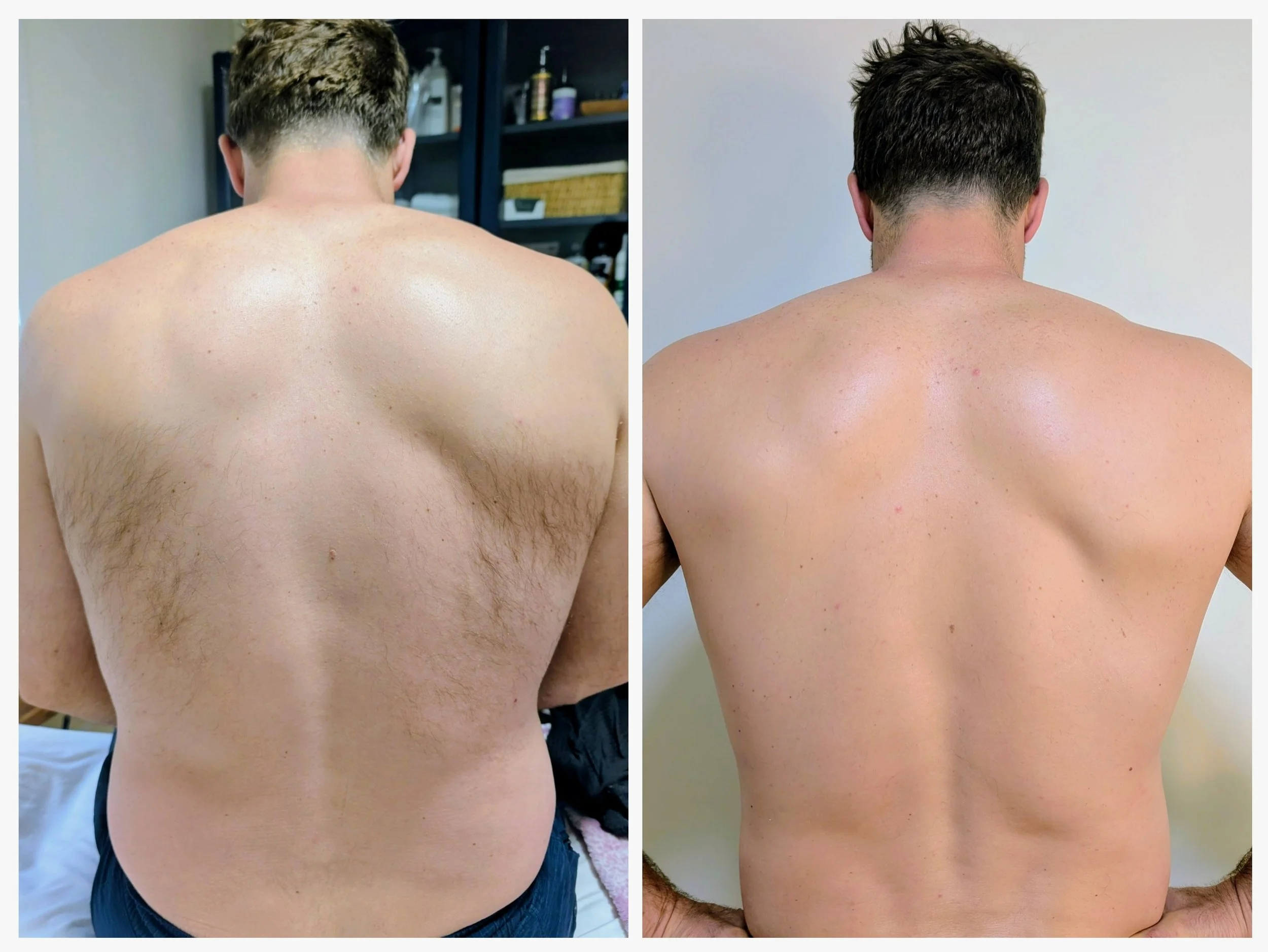 laser hair removal