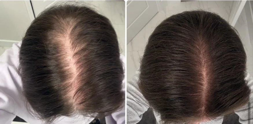 My Hair Growth Journey with 5% Minoxidil                                    
