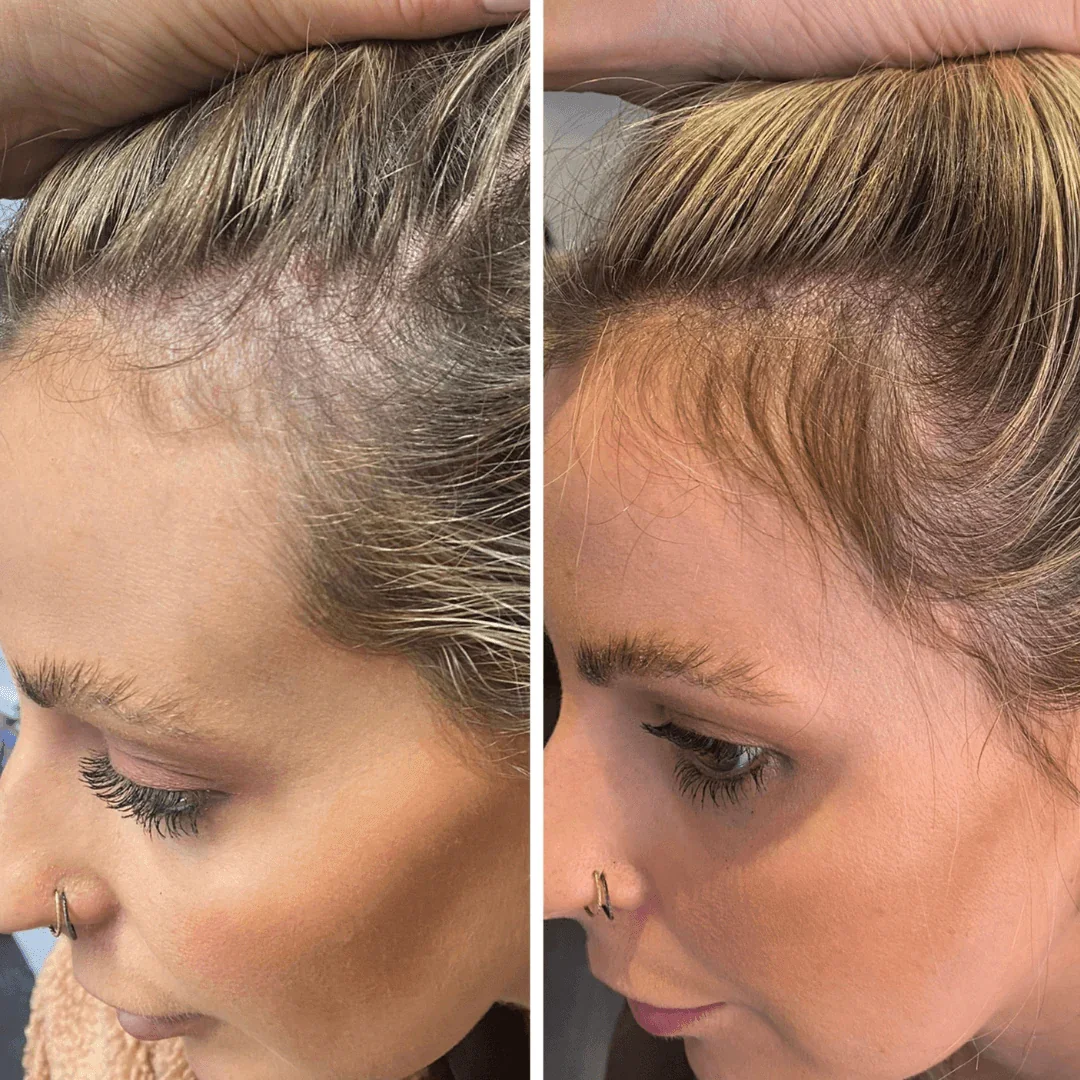 Before_and_after_hair_growth_helmet_1.webp