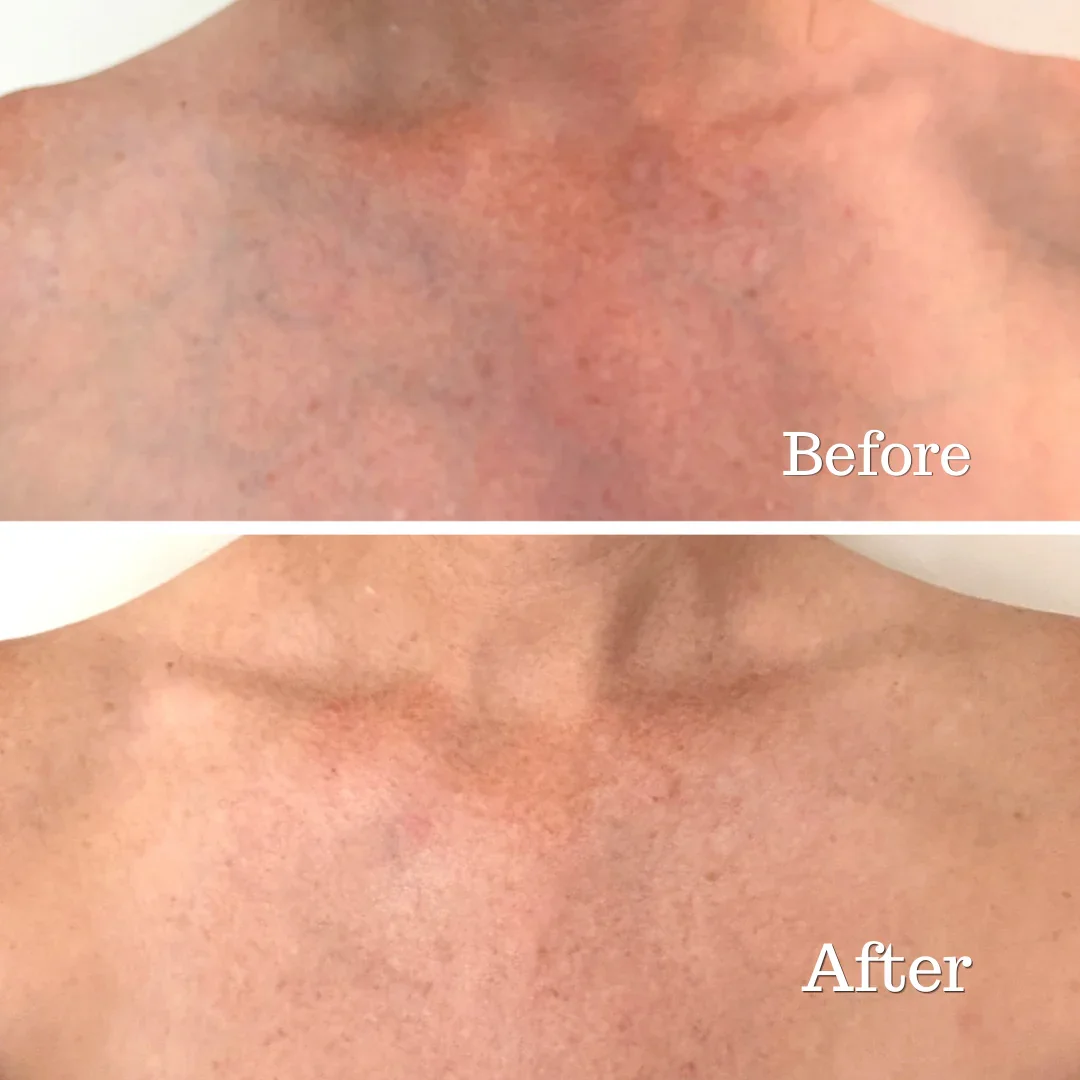 Before_After_Neck.webp