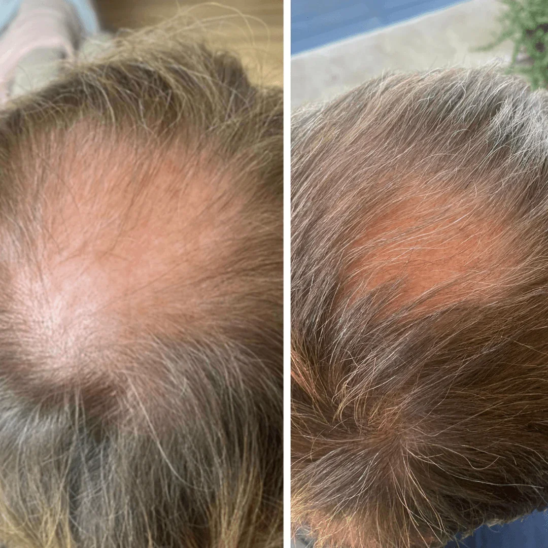Before_and_after_Halo_hair_growth.webp