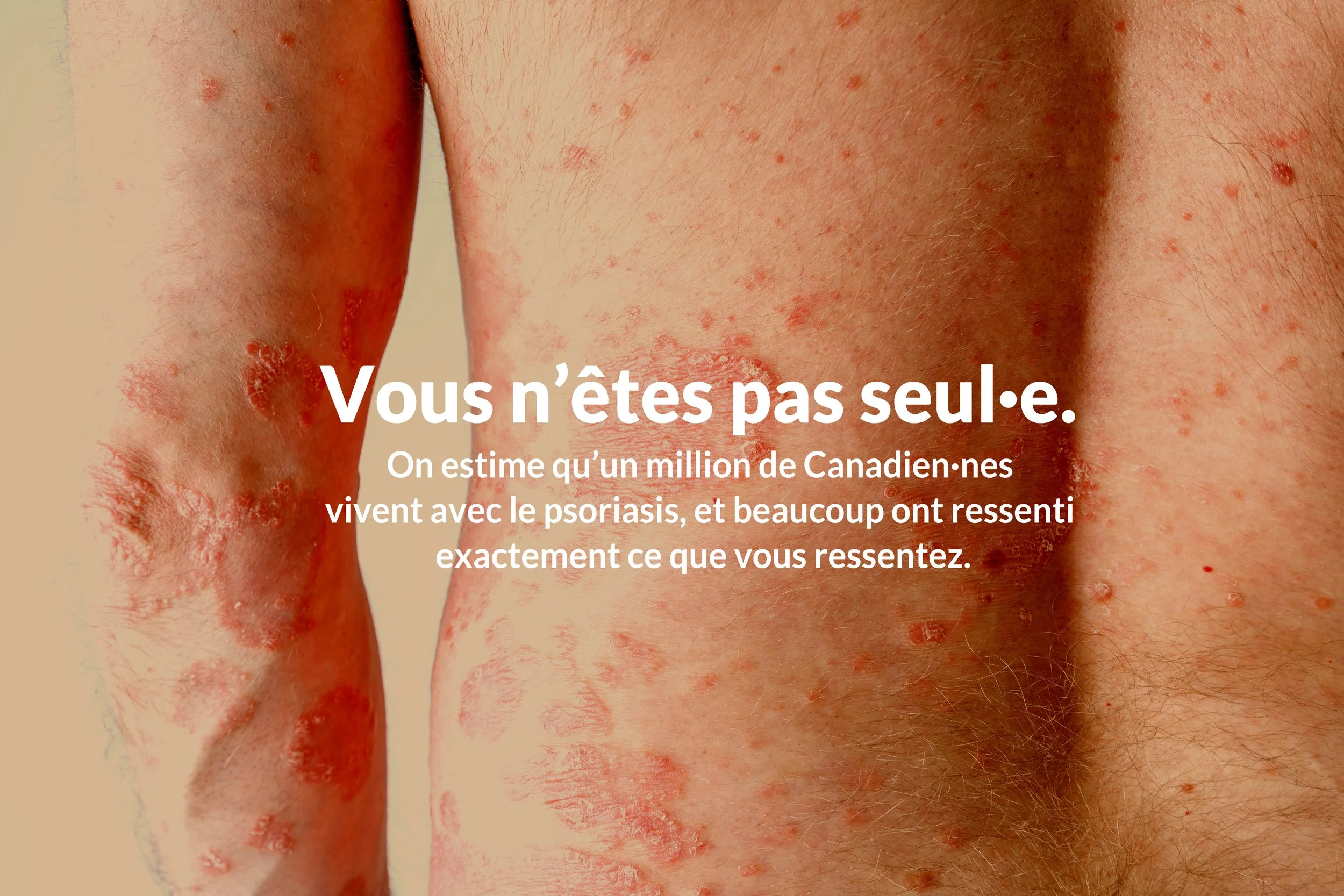 Gros plan d’une peau touchée par le psoriasis, montrant des plaques rouges et squameuses.