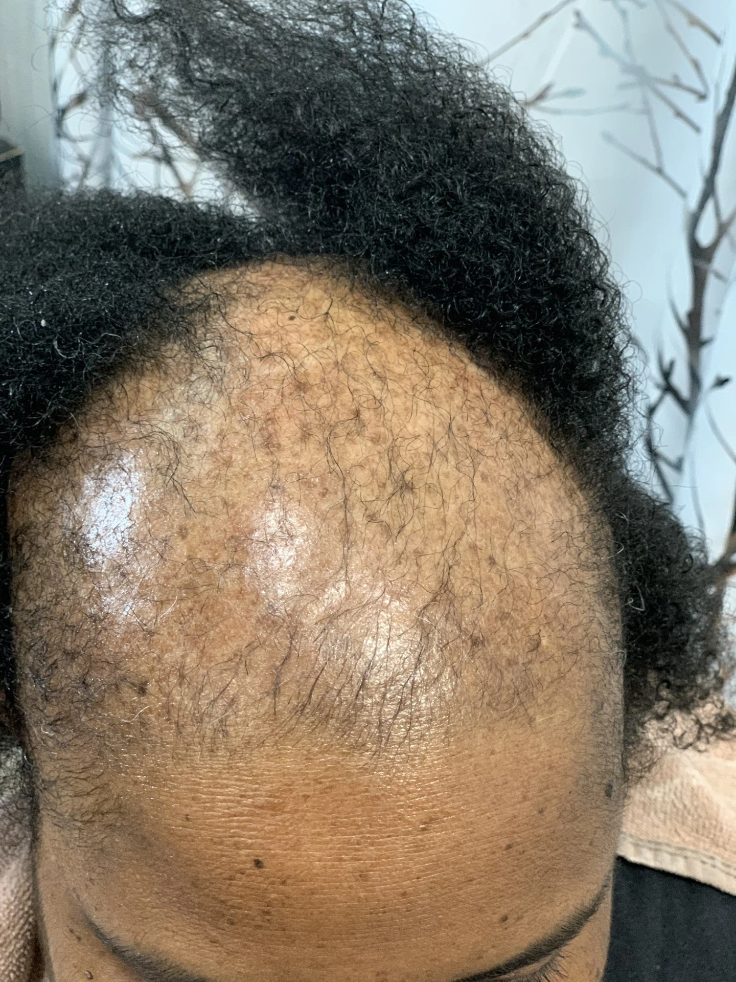 Close-up of a person's forehead with some skin issues and curly hair on the top of the head.