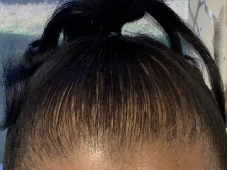 Close-up of a person's forehead and hair with a pulled-back hairstyle, showing natural hair texture.