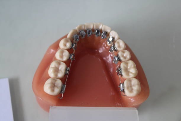 Lingual hidden braces