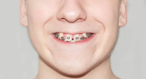Combined orthodontic and restorative care