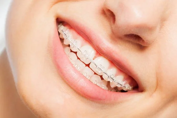 Clear ceramic fixed braces