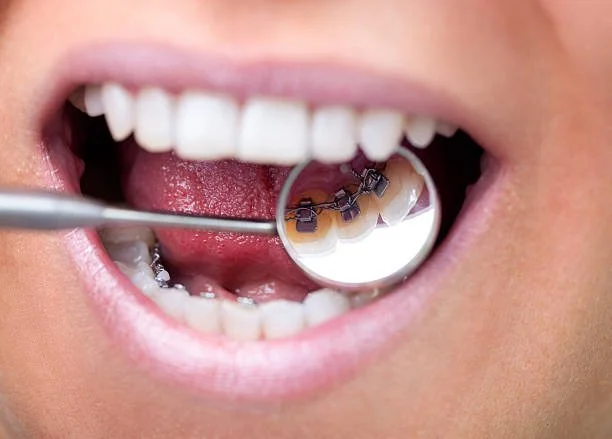 Lingual (hidden) braces