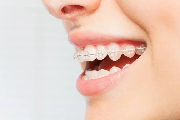 Clear ceramic fixed braces