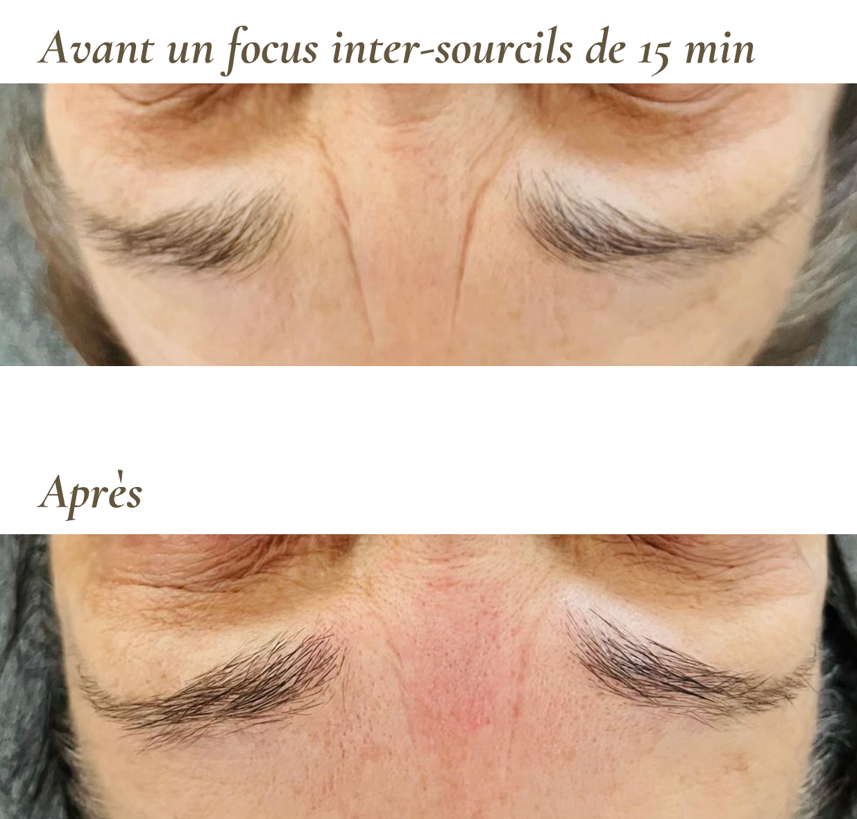 Massage du visage sur-mesure pour défroisser la ride du lion
