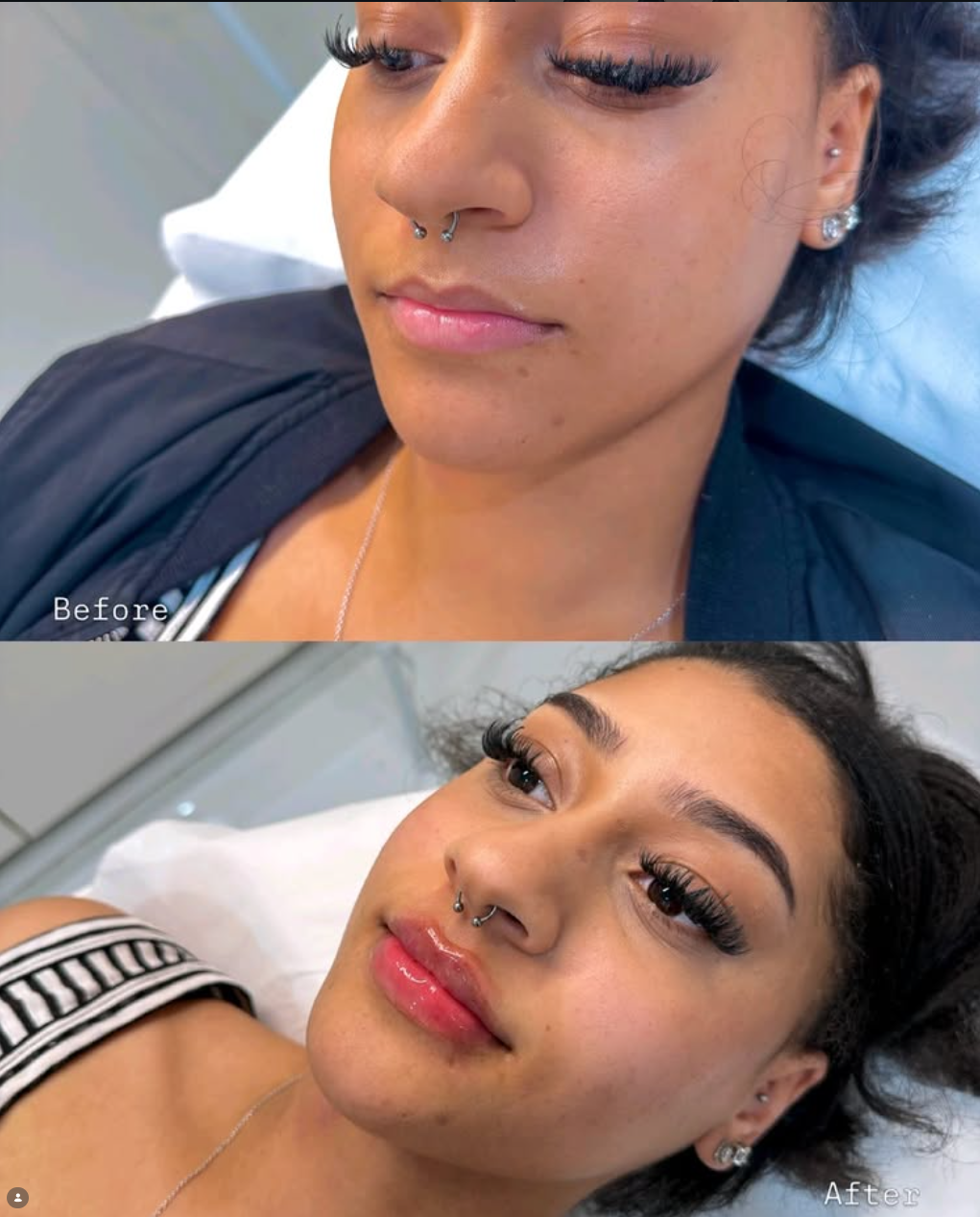 Side-by-side comparison of a woman's face before and after cosmetic procedure, showing improved skin and enhanced eyelash appearance. 	RUSSIAN LIP FILLER
ICCY BEAUTY