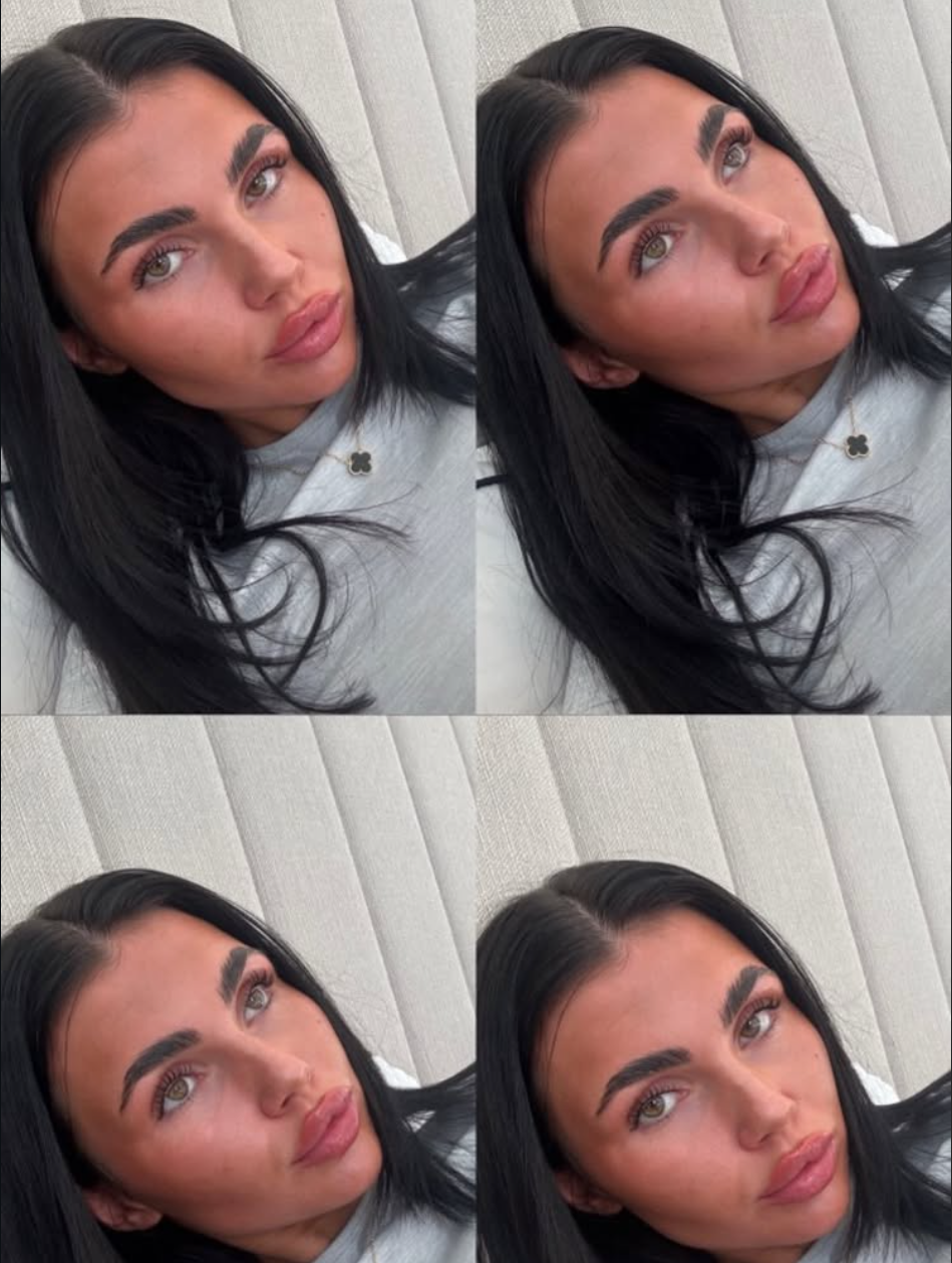 A collage of four close-up photos. TESTIMONIAL PHOTO FEATURING CONTOUR AND LIP FILLER