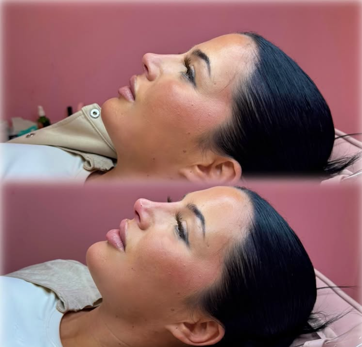 Side view of a woman lying down with eyes closed, dark hair slicked back, wearing a beige top, in a pink room with skincare products in the background.  DERMA FILLERS