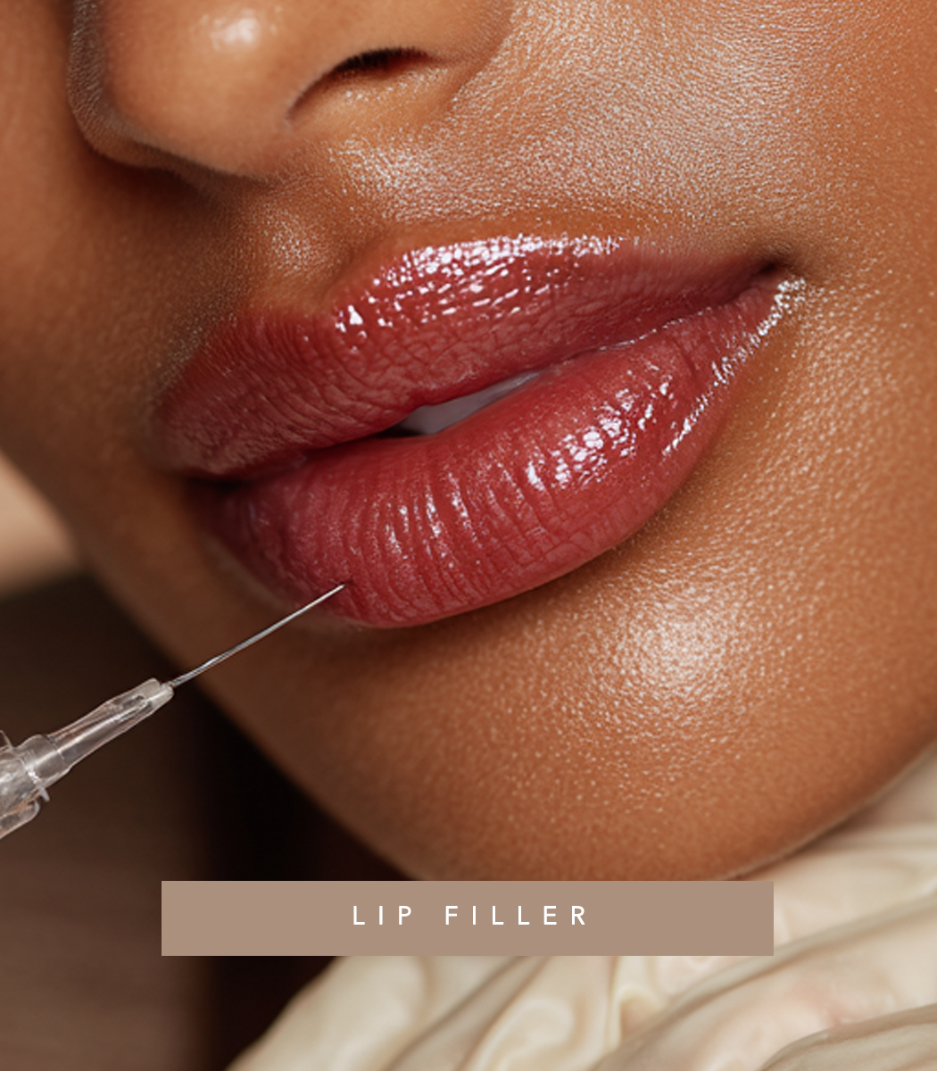 Close-up of a woman’s lips with a syringe near her lower lip, indicating lip filler procedure.