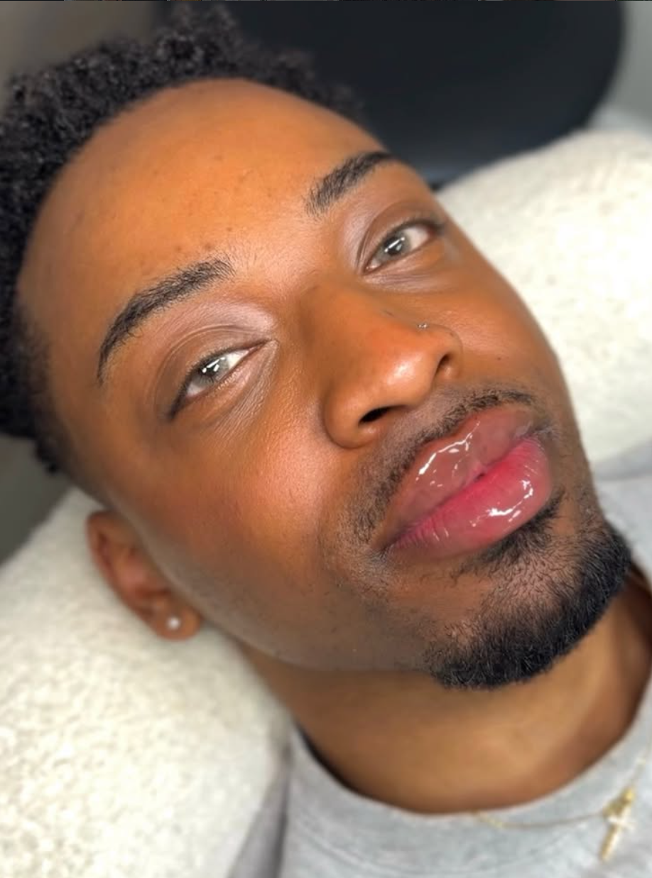 Close-up of a person lying down with their head tilted, looking at the camera. They have short, natural hair, a nose piercing, and glossy lips. RUSSIAN LIP FILLER