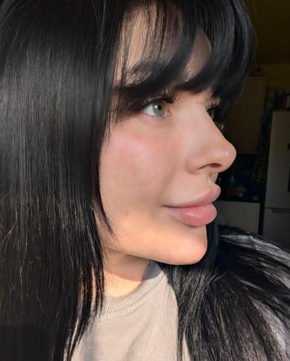 Close-up side profile of a woman with black hair, green eyes, and light skin, looking to the right.  DERMA FILLERS