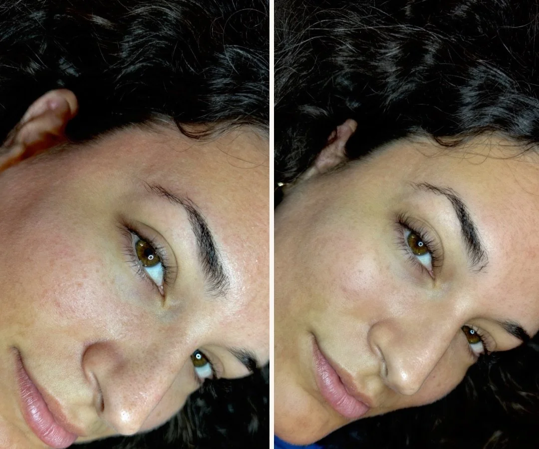 Close-up of a woman's face showing before and after skin treatment, with visible improvement in skin texture.