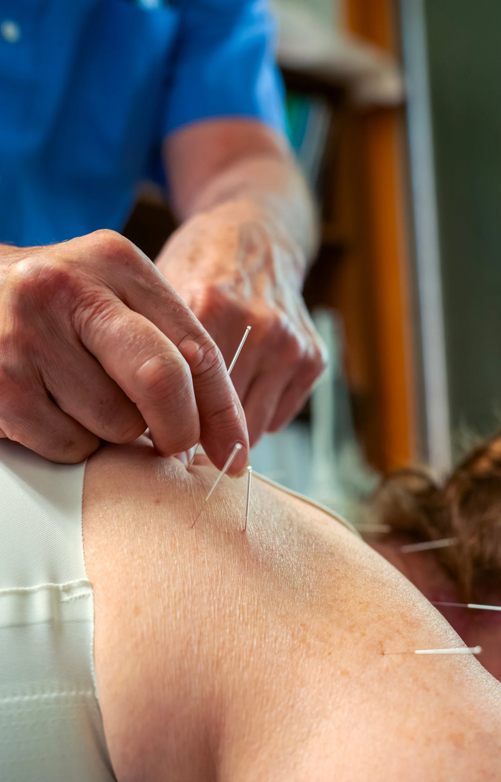 A person receiving acupuncture treatment, with multiple acupuncture needles inserted into their back.