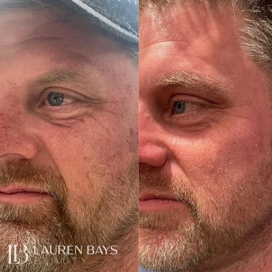 BBL + MOXI = a brighter, smoother, more even complexion🤍 

A little laser reset goes a long way. ✨

This Moxi + BBL combination targets the visible and underlying signs of sun damage, uneven pigmentation, redness, collagen loss and texture issues to