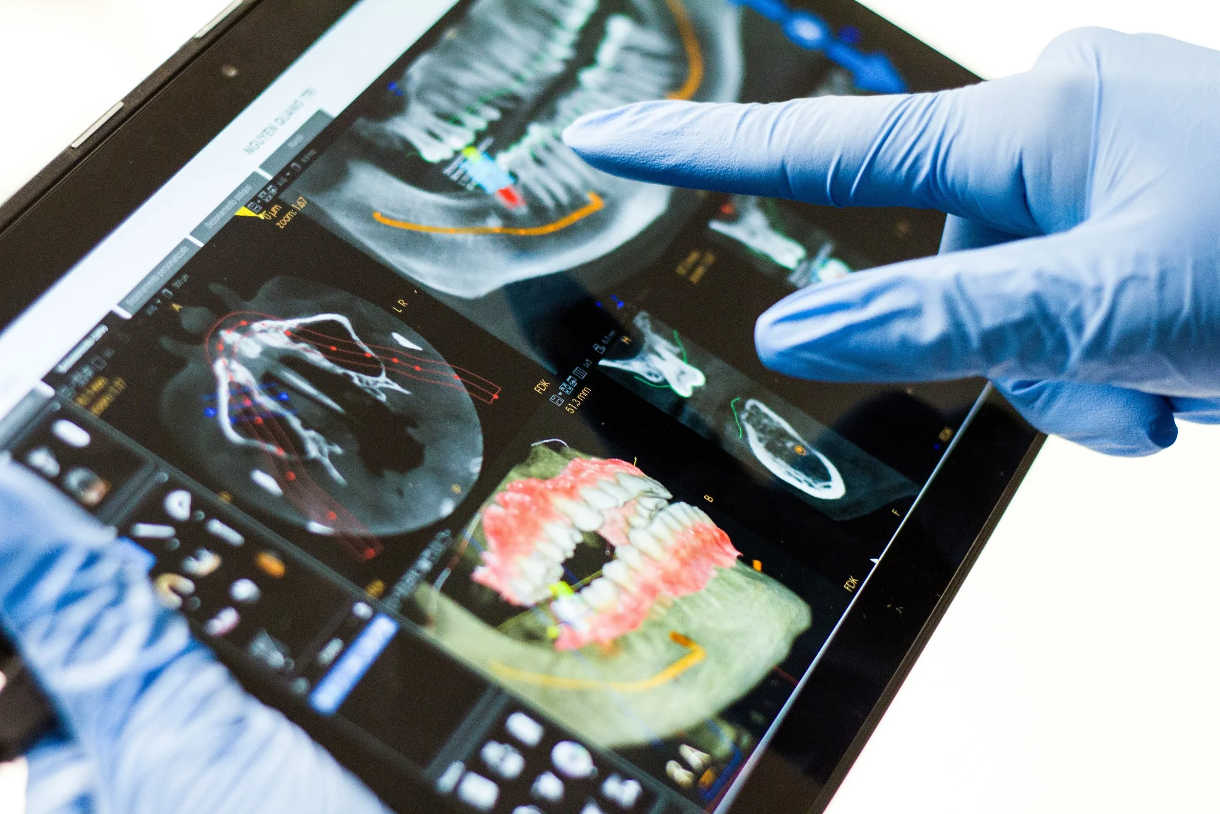Bone grafting procedure at Oral Surgery + of Shreveport for implant preparation