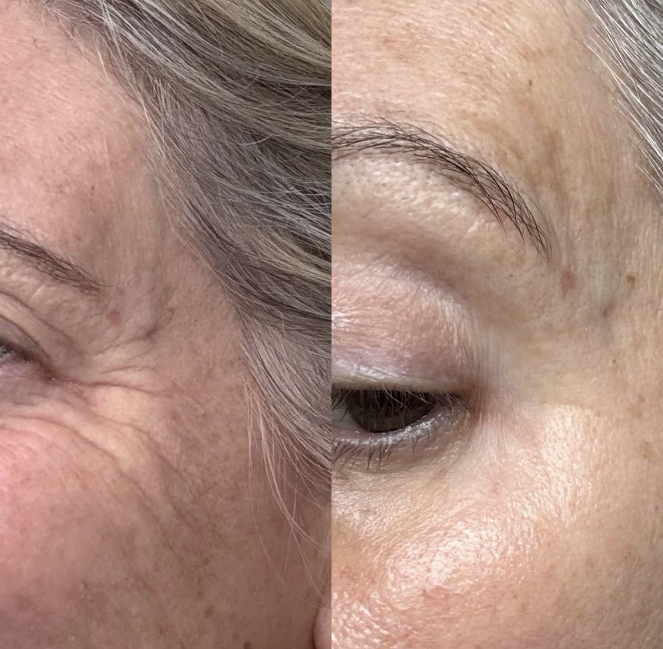 Close-up comparison of a person's face showing skin and eyebrow before and after treatment, with visible improvement in skin texture and appearance.