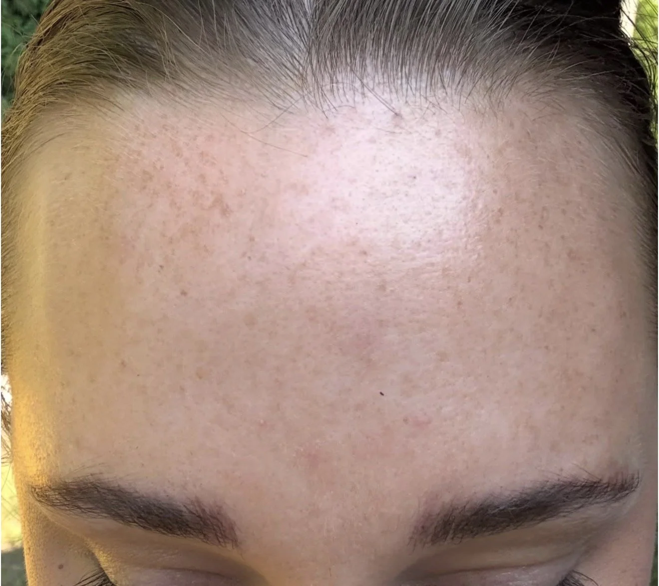 Close-up of a person’s forehead with visible pores and some freckles, with eyebrows and closed eyes visible at the bottom.