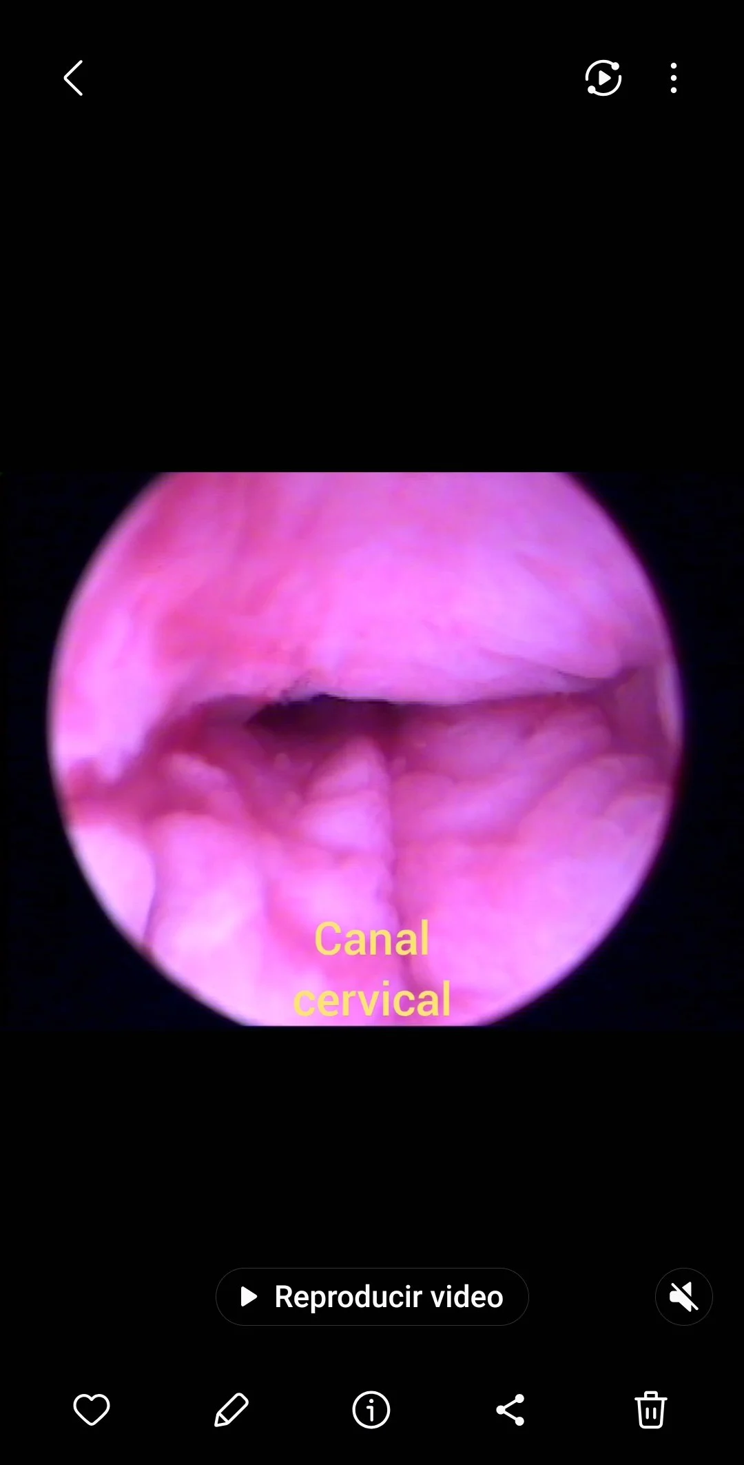 vista histeroscopica del canal cervical uterino . dr. Javier oviedo .