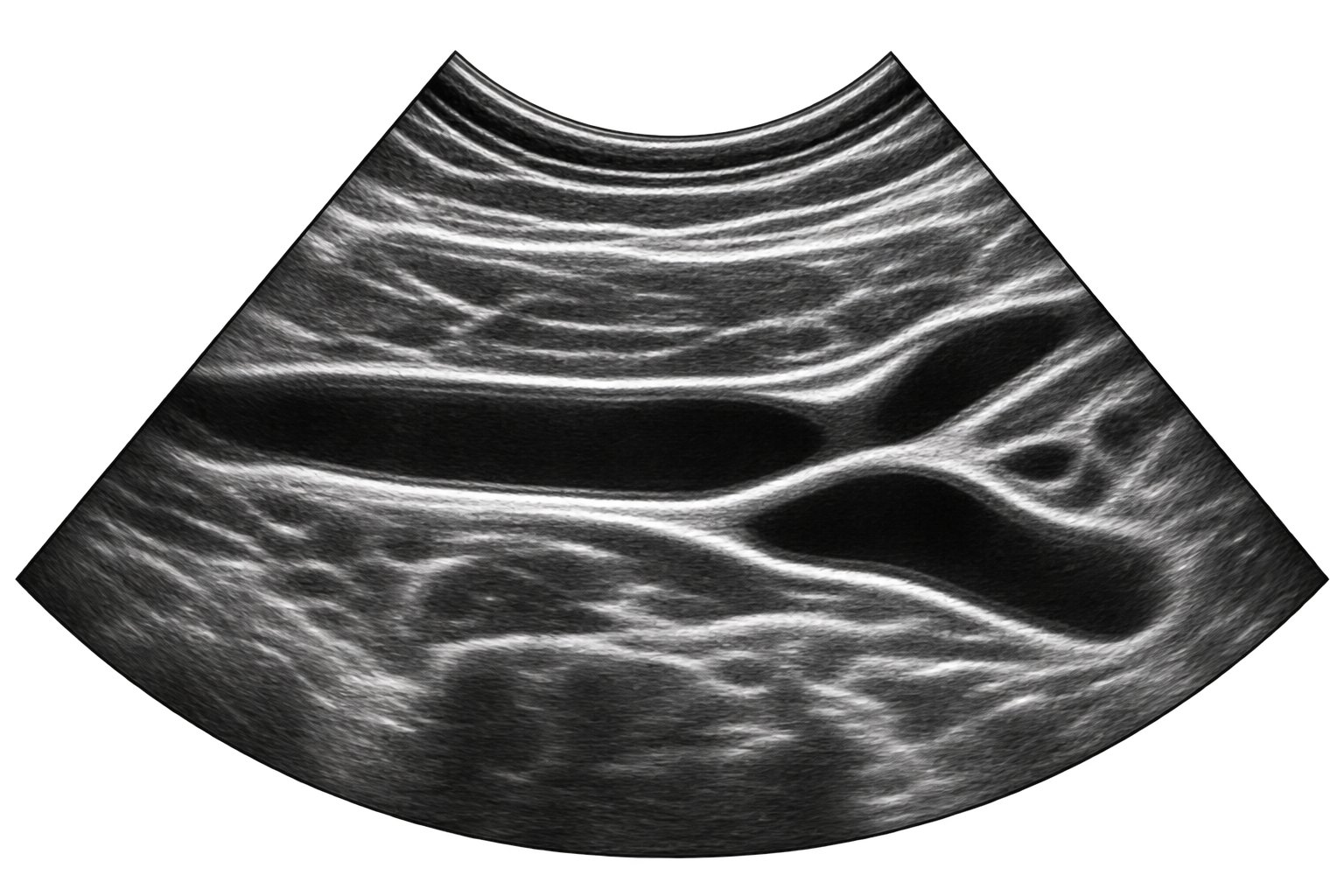 Ultrasound image showing multiple black fluid-filled sacs within tissue, likely consistent with ovarian cysts.