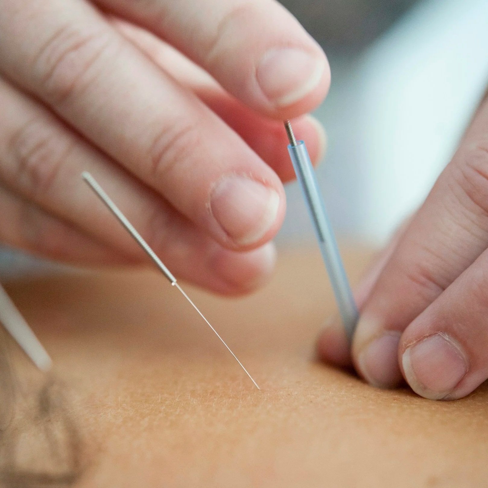 Close-up of a person receiving an acupuncture treatment, with a thin acupuncture needle being inserted into their skin.