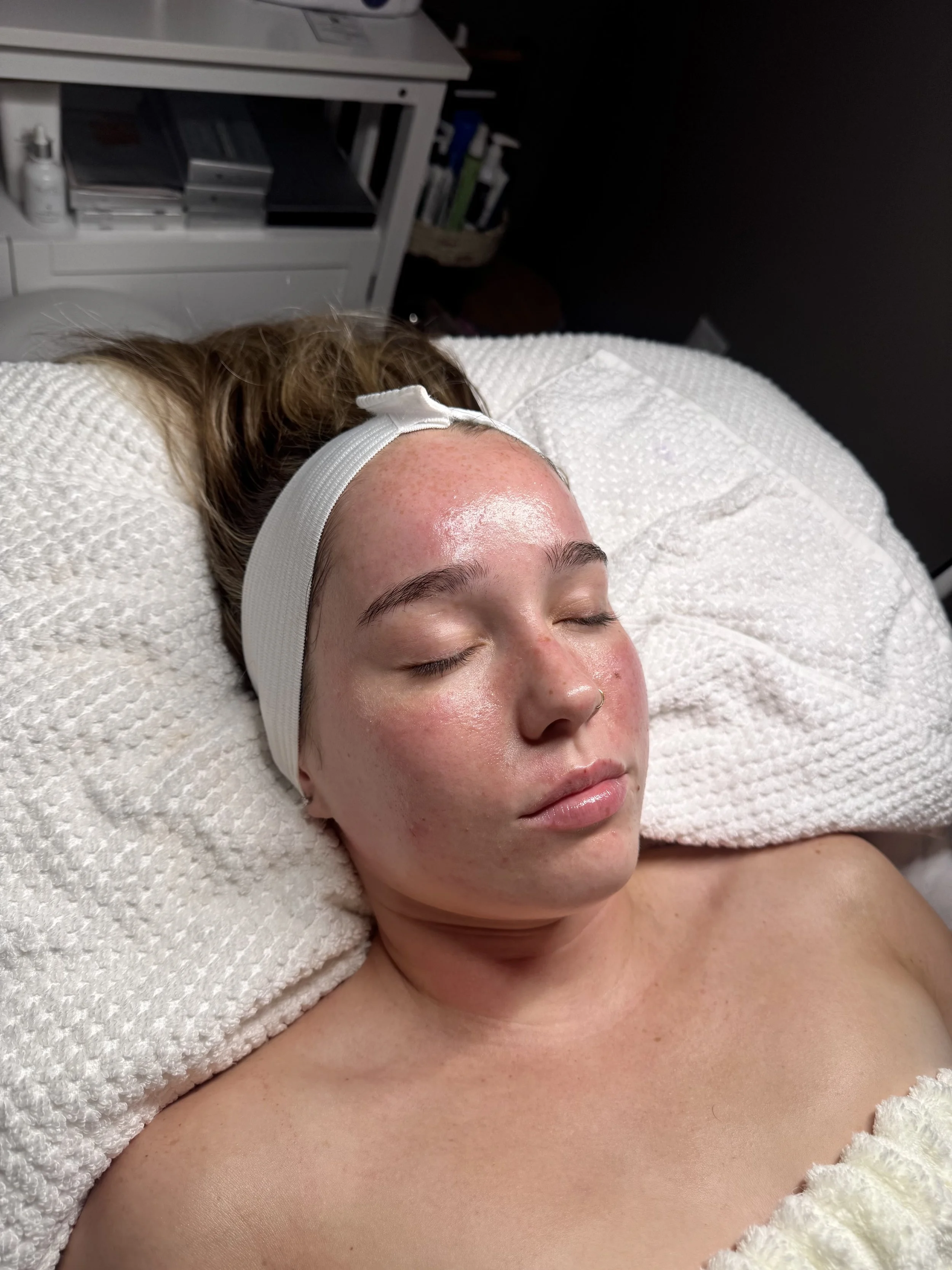 Frozen Facial
