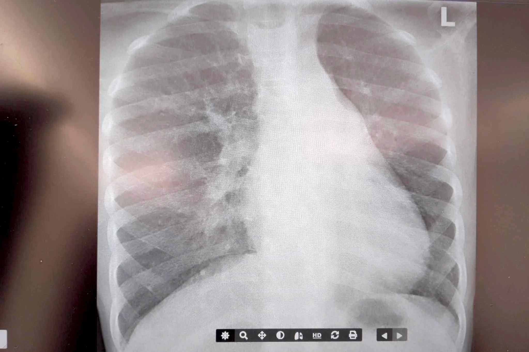 X-ray image of a human chest showing ribs, spine, and lungs.©odoVita