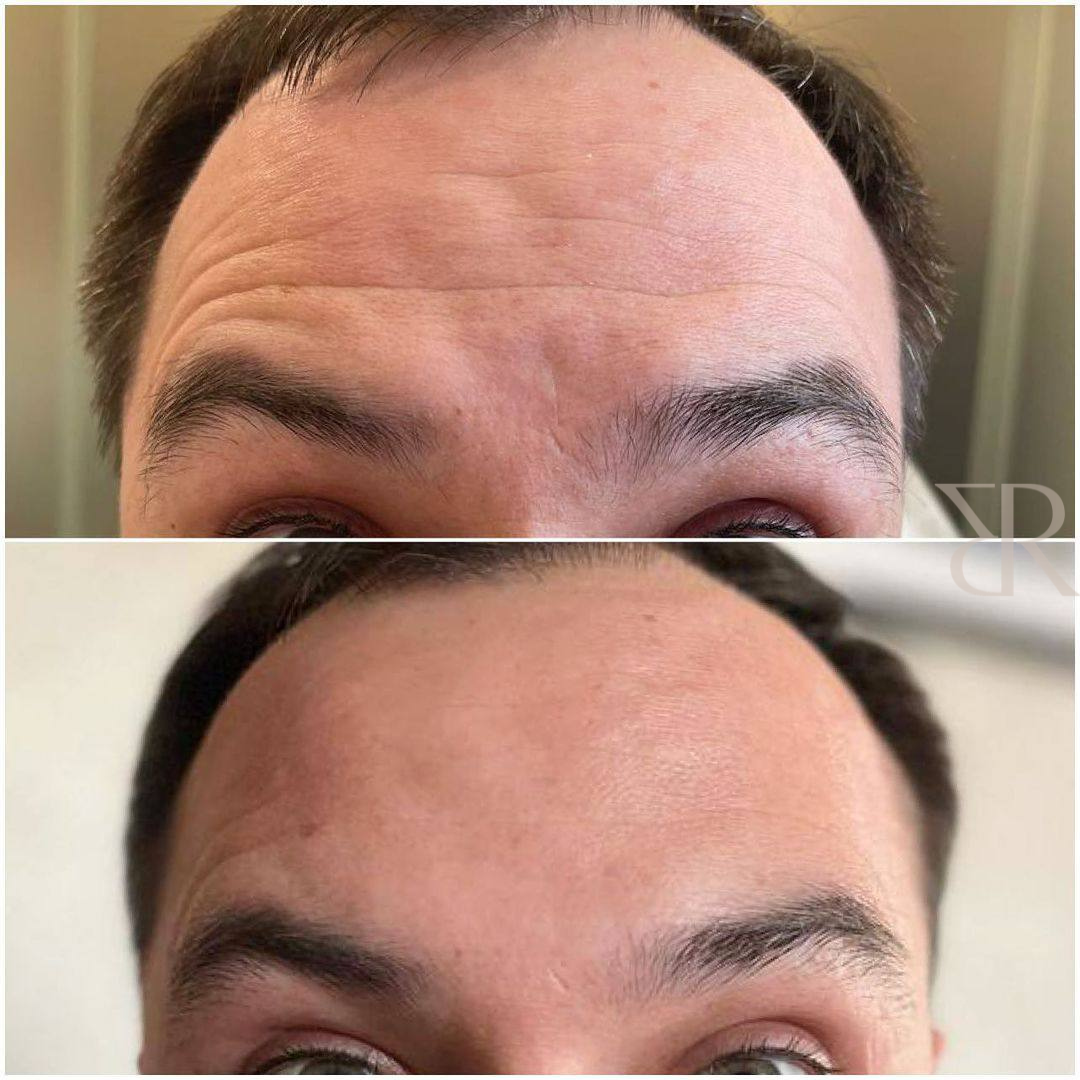 Copy of botox before & after - 6.png