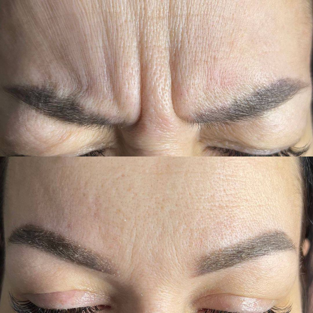 Copy of botox before & after - 17.png